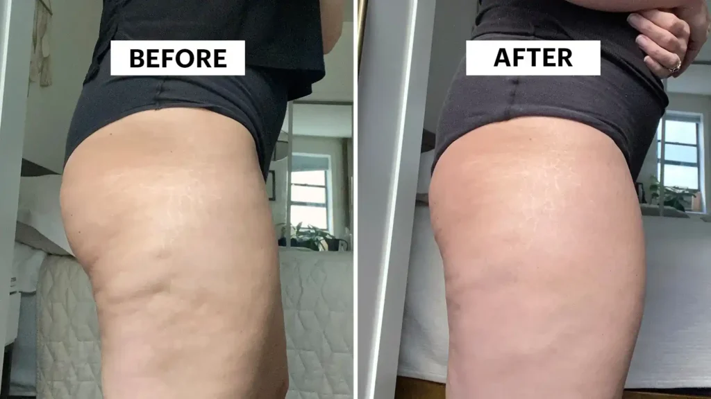 Do Toning Exercise Addlestone Really Tackle Cellulite?