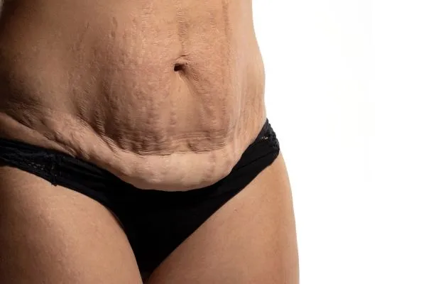 The science behind skin tightening Addlestone picture of a woman's sagging skin on the stomach